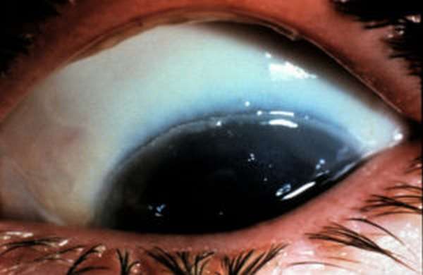 фото химического ожога роговицы глаза